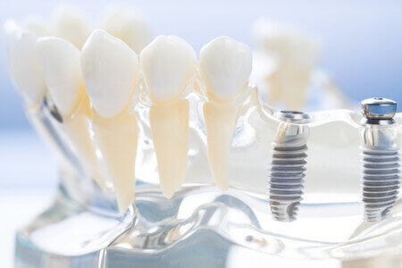 Transforming Smiles: The Impact of Dental Implants