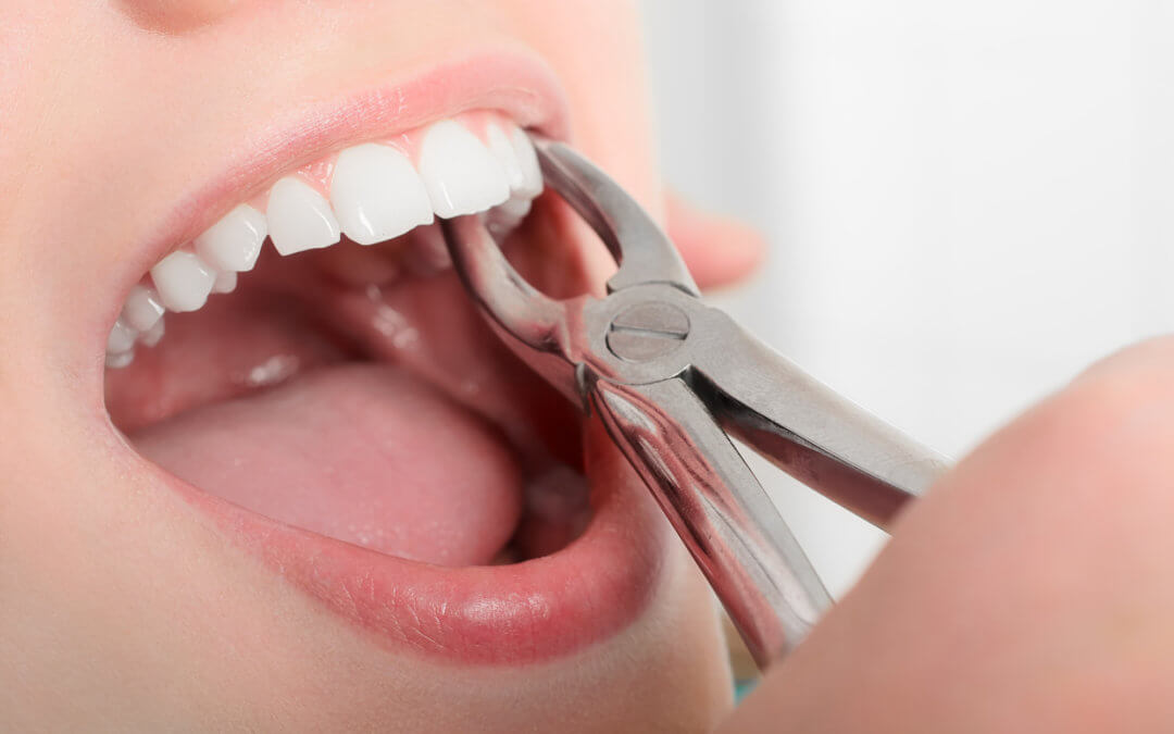 Is a Tooth Extraction Painful? An Oral Surgeon Weighs In