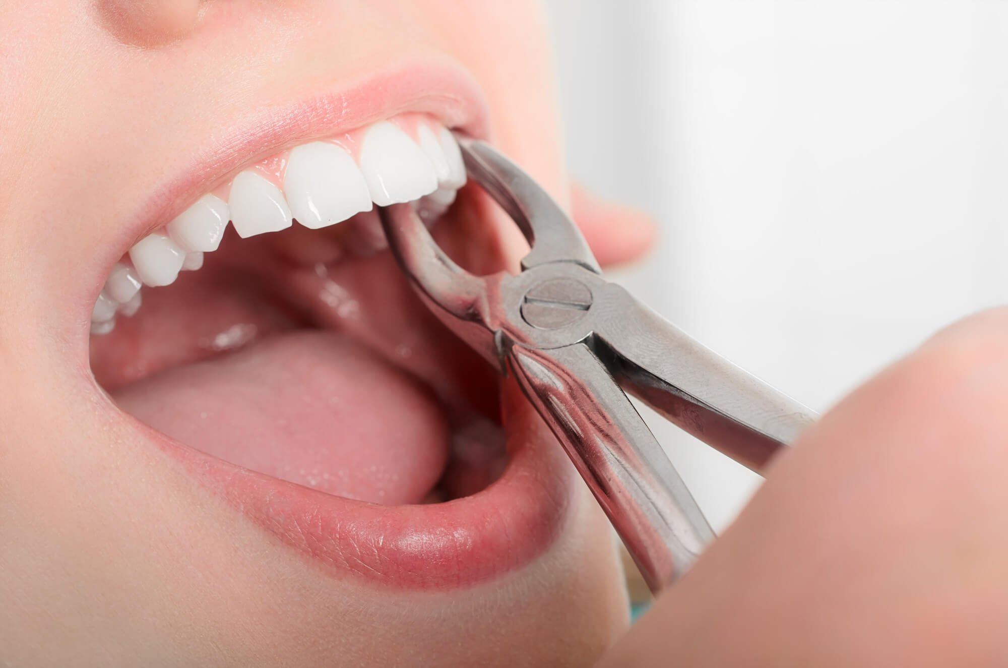 tooth extraction treatment