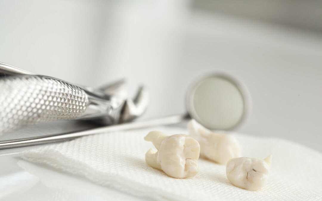 Should You Remove Your Wisdom Teeth? What You Need to Know
