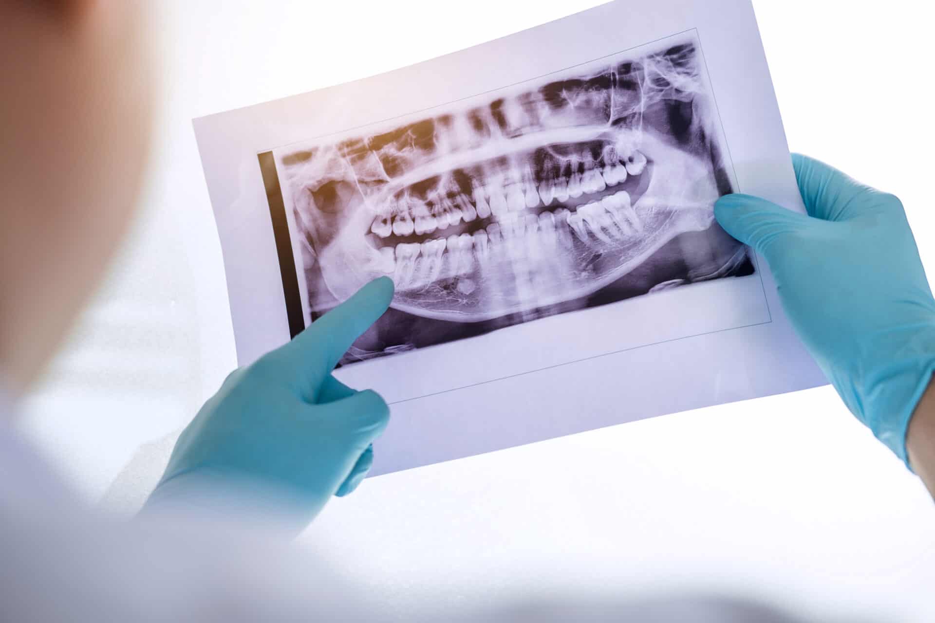 Oral xray examination - oral surgery Boise Oral Surgery and Dental Implant Center