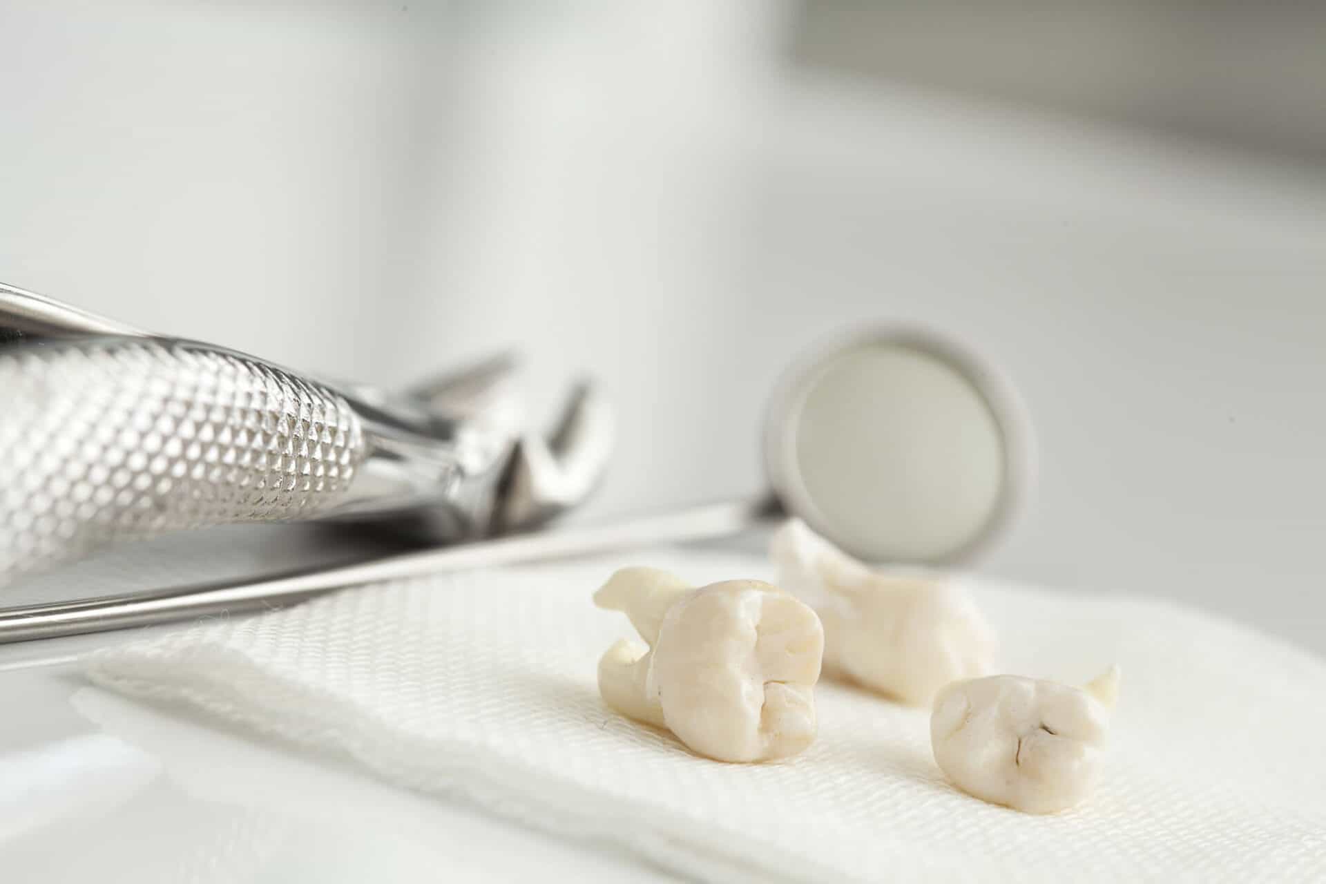 should you remove wisdom teeth